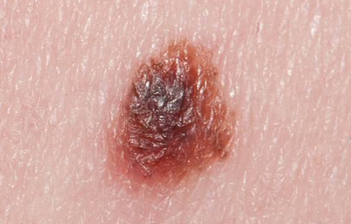 Melanoma