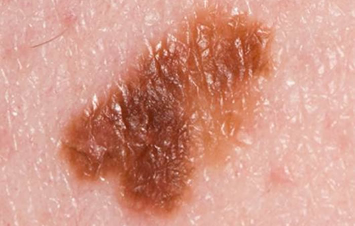 Melanoma