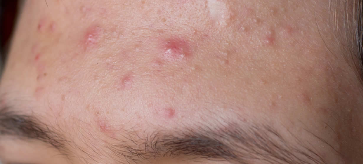 best acne treatment for me